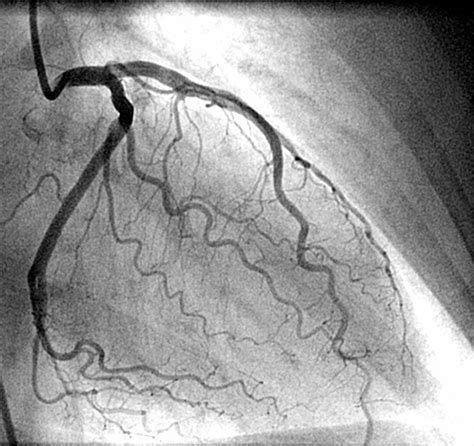 Coronary Angiography A Tool To Diagnose Cad In Acute Heart Failure