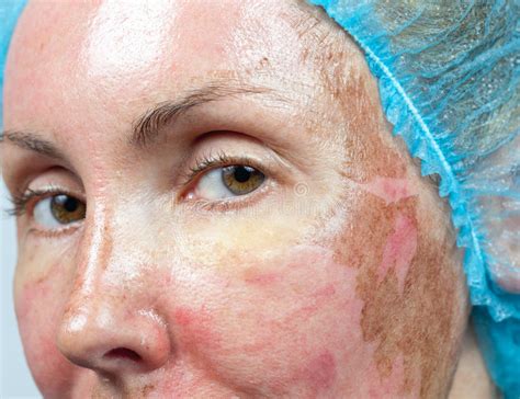 Cosmetology Skin Condition After Chemical Peeling Tcatop Burned Layer