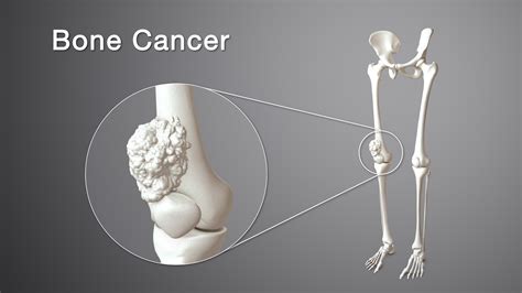 Bone Cancer Types Symptoms Causes And Treatment Scientific Animations