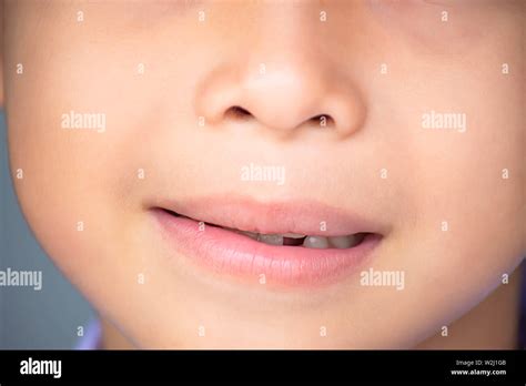 Baby Teeth Are Just Dropped In The Mouth Stock Photo Alamy