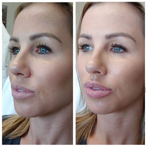 Lip Injections Before And After Juvederm