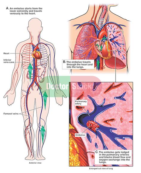 Mechanism Of Pulmonary Embolism Doctor Stock