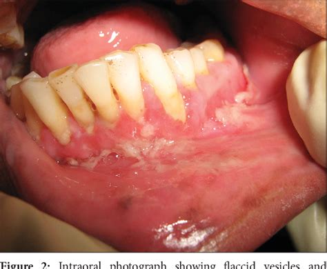 Figure 1 From Successful Treatment Of Oral Pemphigus Vulgaris Using