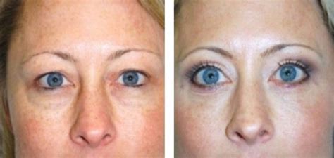 Eyelid Plastic Surgery Before And After Before And After