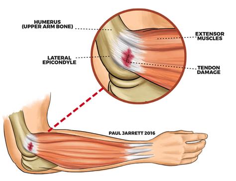 Elbow Injury Torn Tendons Tendonitis Repair Atelier Yuwaciaojp