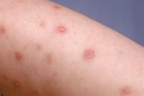 Red Itchy Bumps On The Skin Causes Picture Symptoms Treatment