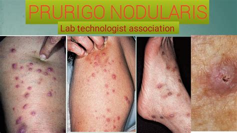 What Is Prurigo Nodularis And How To Management It Youtube