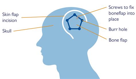 Craniotomy Fact Sheet Health Information Brain And Spine Foundation