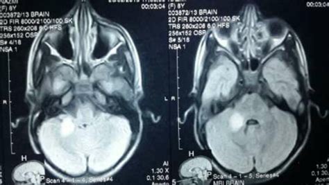 Mri Brain Showing Revealed T2 Hyperintensities In Right Middle