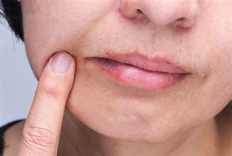 Home Remedies For Angular Cheilitis Cracked Mouth Corners Top 10