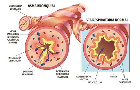Diferencia entre Bronquitis y Asma El Botiquín Natural