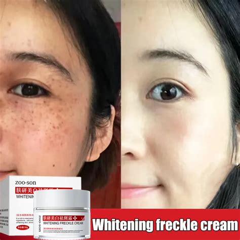 Dark Spot Corrector Cream Whitening Freckle Cream Powerful Removing