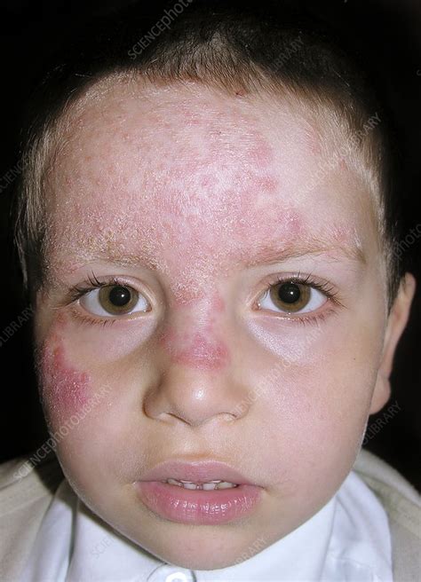 Tinea Fungal Infection On The Face Stock Image C0142548 Science