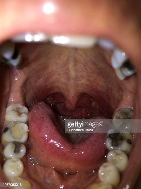 Swollen Tonsils Photos And Premium High Res Pictures Getty Images