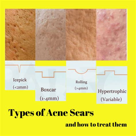What Causes Acne And Acne Scars And Treatments Dr Cindys Medical