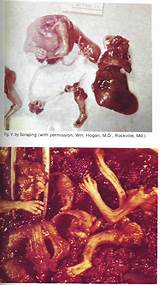 Photos of How Do Doctors Perform An Abortion