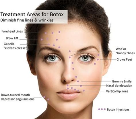 Botox Eyebrow Lift Injection Sites Facial Fillers Botox Fillers