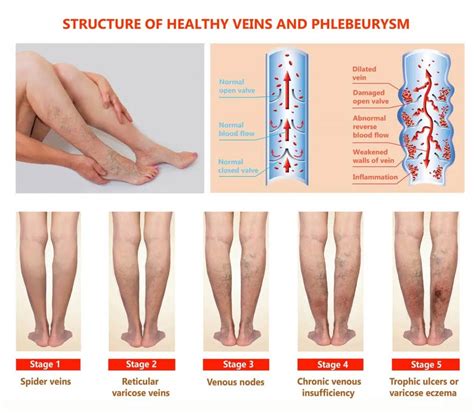 What Are The Dangers Of Deep Vein Thrombosis Dvt Woms