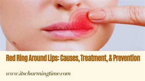 Red Ring Around Lips Causes Treatment And Prevention Its Charming Time