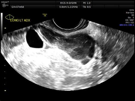 Sonographic Detection Of Ovarian Ectopic Pregnancy A Case Study