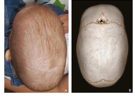 Figure From Surgical Correction Of Craniosynostosis A Single