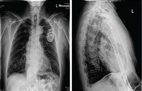 Chest X Rays Posterior Anterior And Lateral Views After Transcatheter