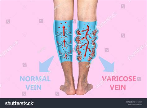 Varicose Veins On Female Senior Legs Stock Photo 1311313031 Shutterstock