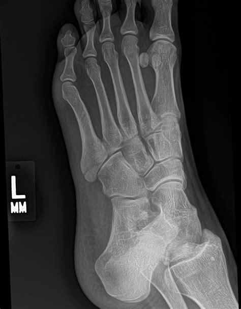 Fifth Metatarsal Fracture Causes Treatment And Recovery Health News Website