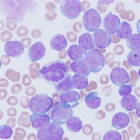 Peripheral Blood Smear Demonstrating A Spectrum Of Immature Mononuclear