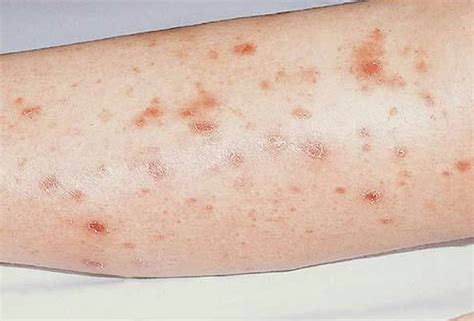 Pityriasis Lichenoides Pictures Causes Symptoms Treatment