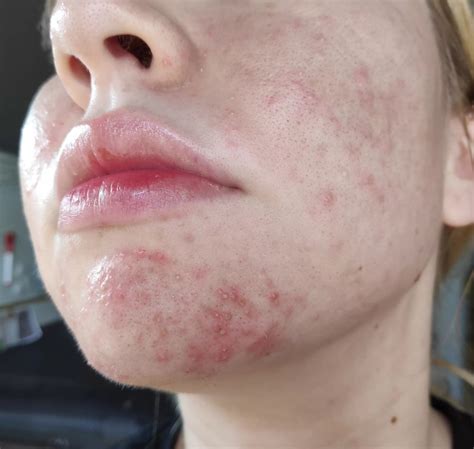 From Fungal Acnefolliculitis To Clear Skin With Pictures The Skin