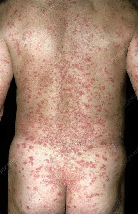 Guttate Psoriasis Stock Image C0261145 Science Photo Library