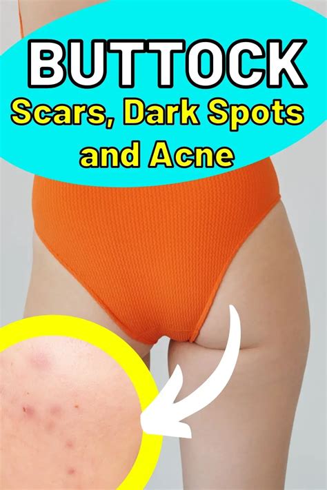 How To Get Rid Of Buttock Scars Dark Spots And Acne Naturally Epic