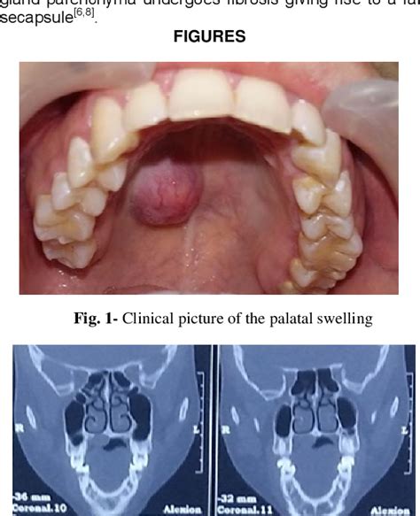 Figure 1 From Pleomorphic Adenoma Of Hard Palate A Case Report