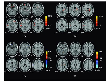A Brain Regions Showing Sex Effects On Falff Among Cd Patients And