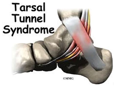 Condition Spotlight Tarsal Tunnel Syndrome Watsonia Podiatry