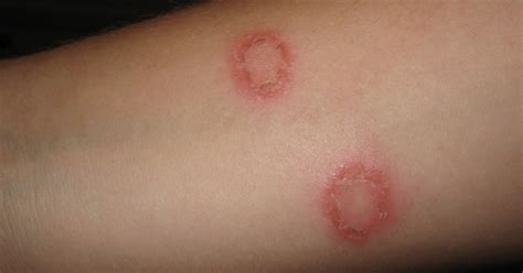 Dd Medical Matters How To Treat A Ringworm Infection Donegal Daily