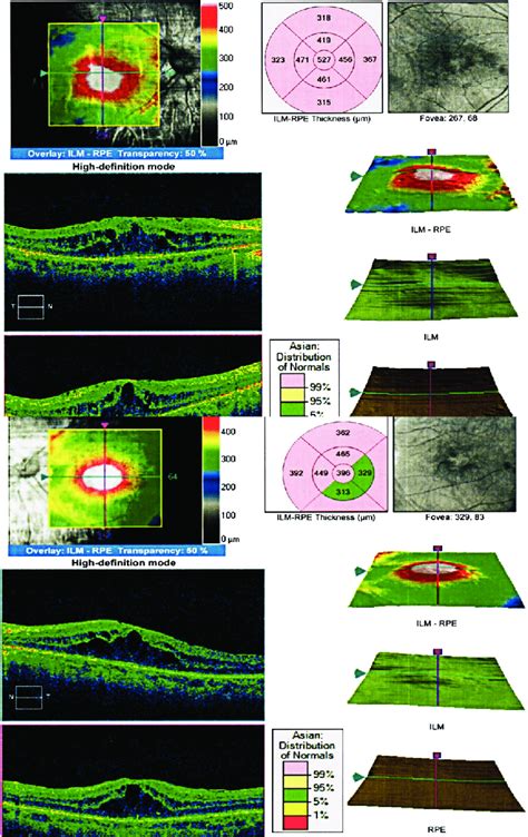 Cystoid Macular Edema Was Shown In OCT Findings For Both Eyes Three Download Scientific Diagram
