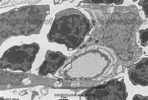 5 pathophysiologie der hodenkrebs ist ein seltener bösartiger tumor, der überwiegend junge männer im alter zwischen 20 und 40 jahren befällt. Blutschranken Dr.Jastrows EM-Atlas