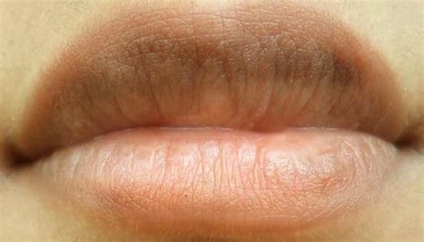 Lip Discoloration Red Spot