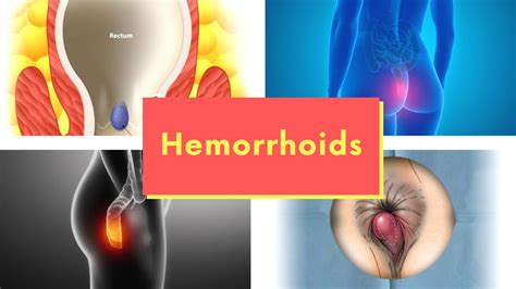 What Causes Hemorrhoids Piles Pictures Signs Symptoms Of Internal And