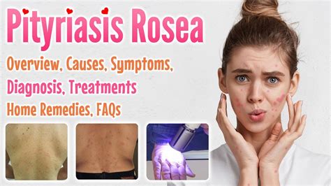 Pityriasis Rosea Overview Causes Sign And Symptoms Diagnosis