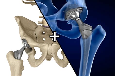 3d Hip Replacement Implant Installed Model Turbosquid 1220758