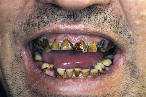 Nicotine Stained And Decayed Teeth Stock Image C0166970 Science