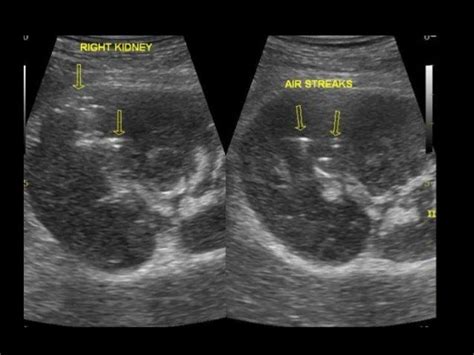Perinephric Abscess Ultrasound Radiology Sonography