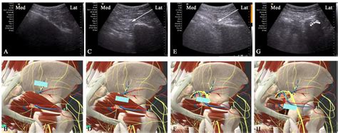 Figure 3 From The Efficacy Of An Ultrasound Guided Improved Puncture