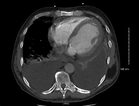 Go ahead for medication and good. CT chest showing bilateral pleural effusions and moderate ...