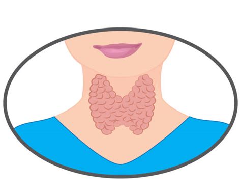 Hypothyroidism Illustrations Royalty Free Vector Graphics And Clip Art