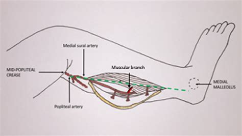 The Chimeric Medial Sural Artery Perforator Flap As The Ideal For