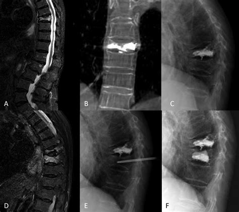 Analysis Of Risk Factors For New Vertebral Fracture After Percutaneous